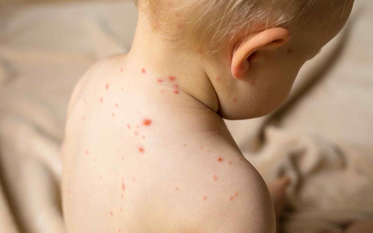 Everything You Need to Know About Measles